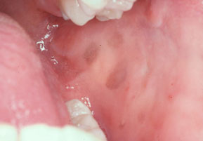 Intraoral Melanoplakias
