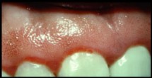 Periodontal Diseases 1