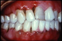 Periodontal Diseases 2