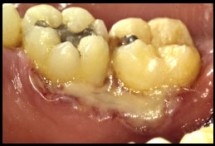 Periodontal Diseases 3