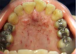 Petechiae